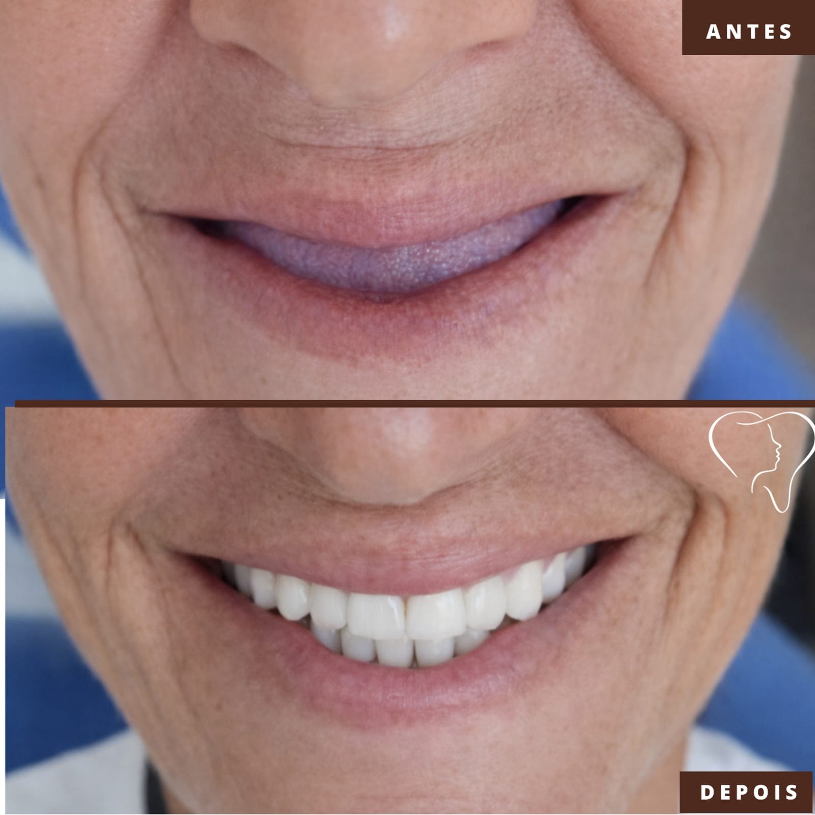 antes-e-depois-implantes-ouro-branco (1)