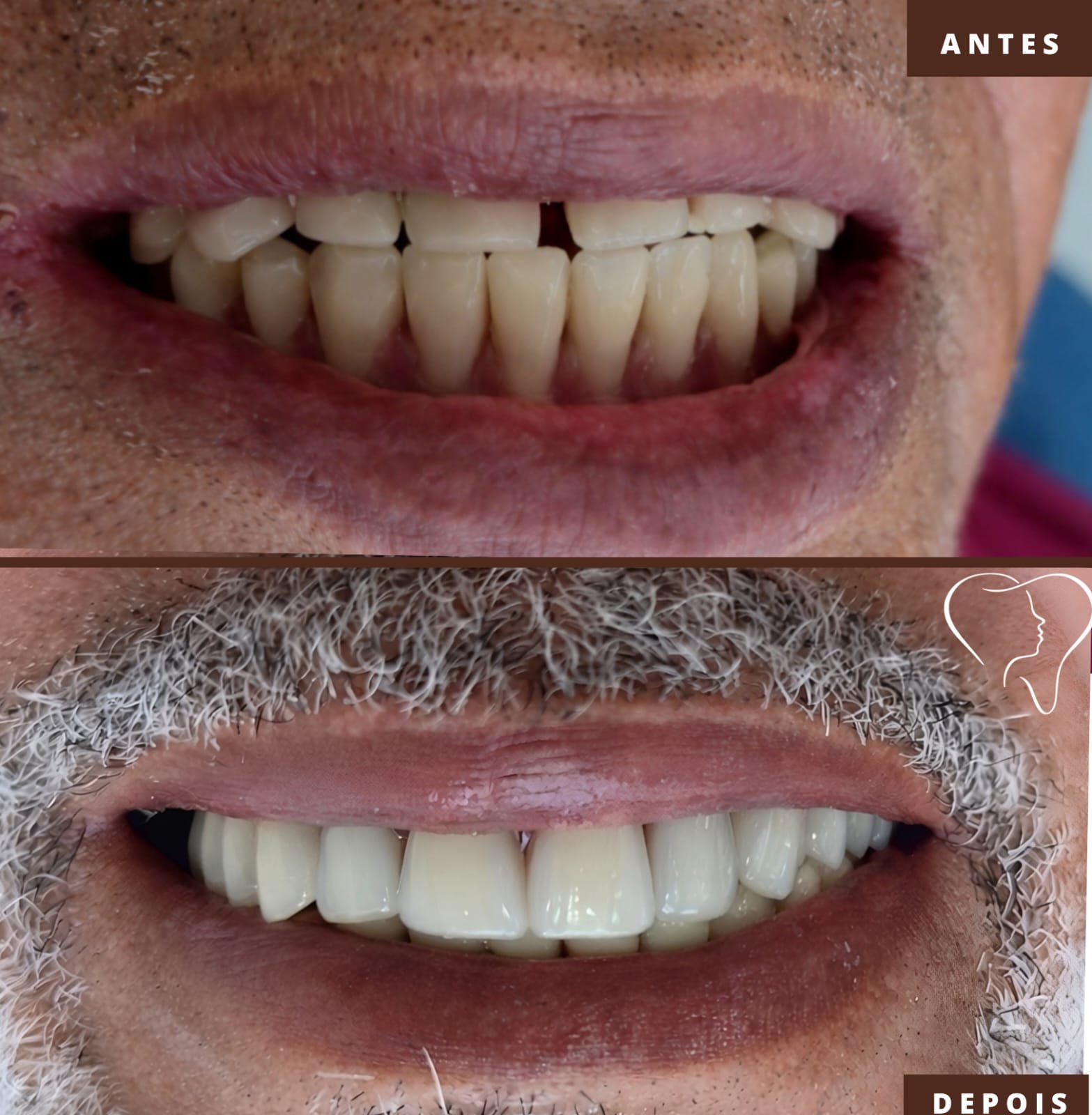 antes-e-depois-implantes-ouro-branco (2)