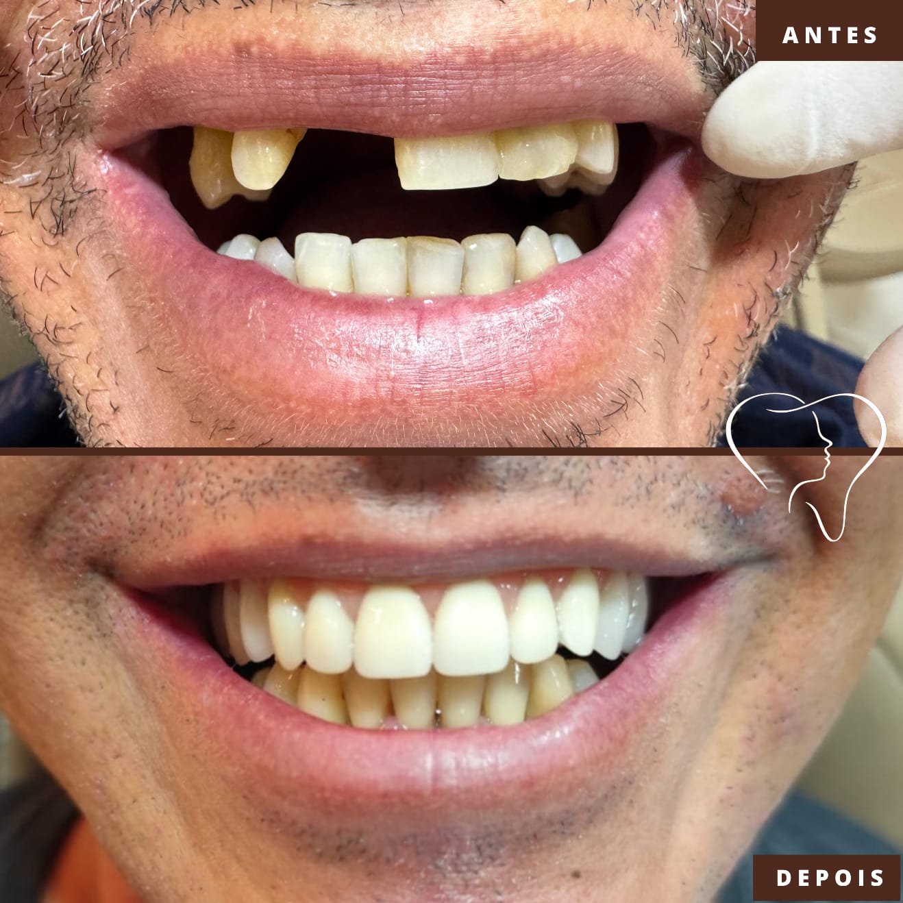 antes-e-depois-implantes-ouro-branco (3)
