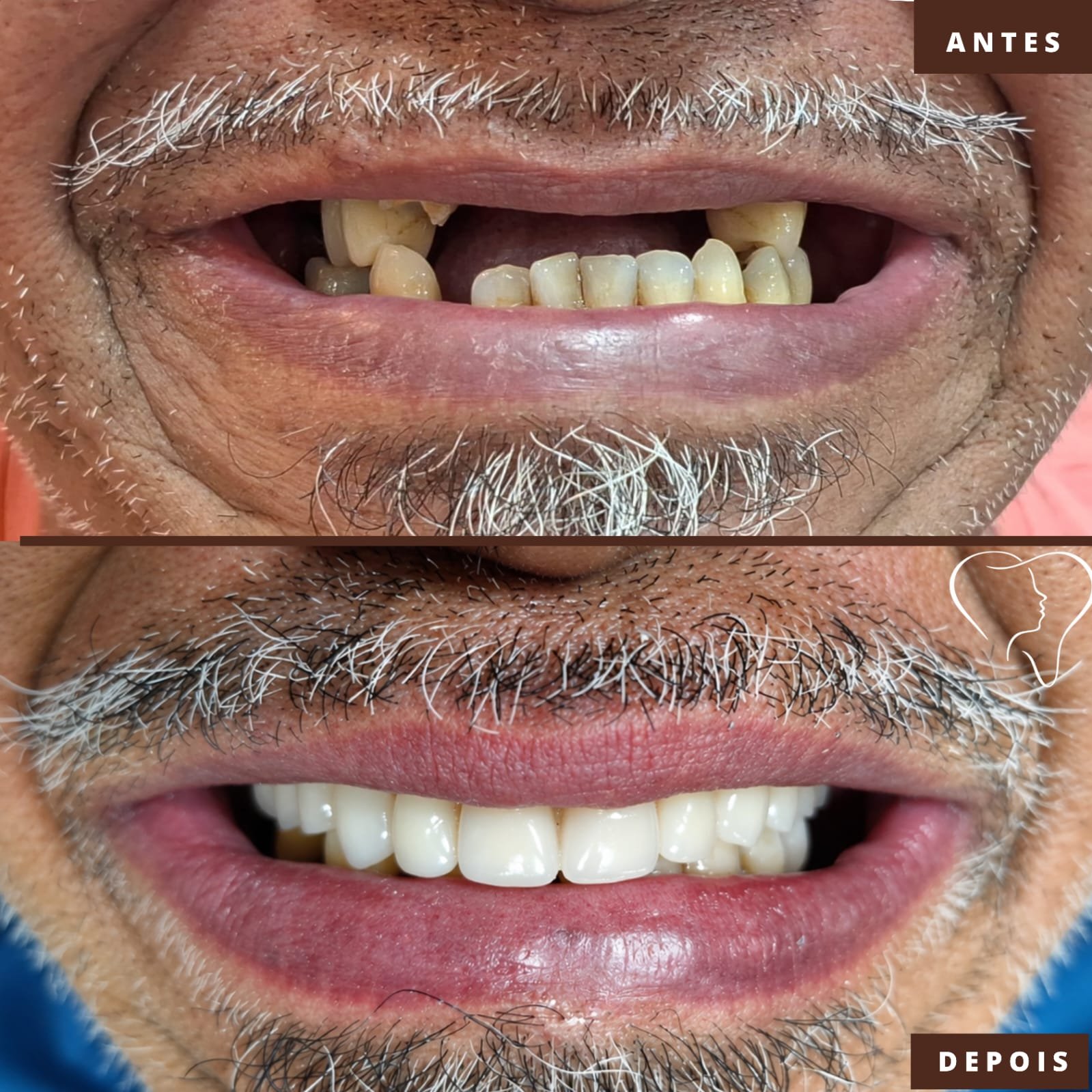 antes-e-depois-implantes-ouro-branco-44