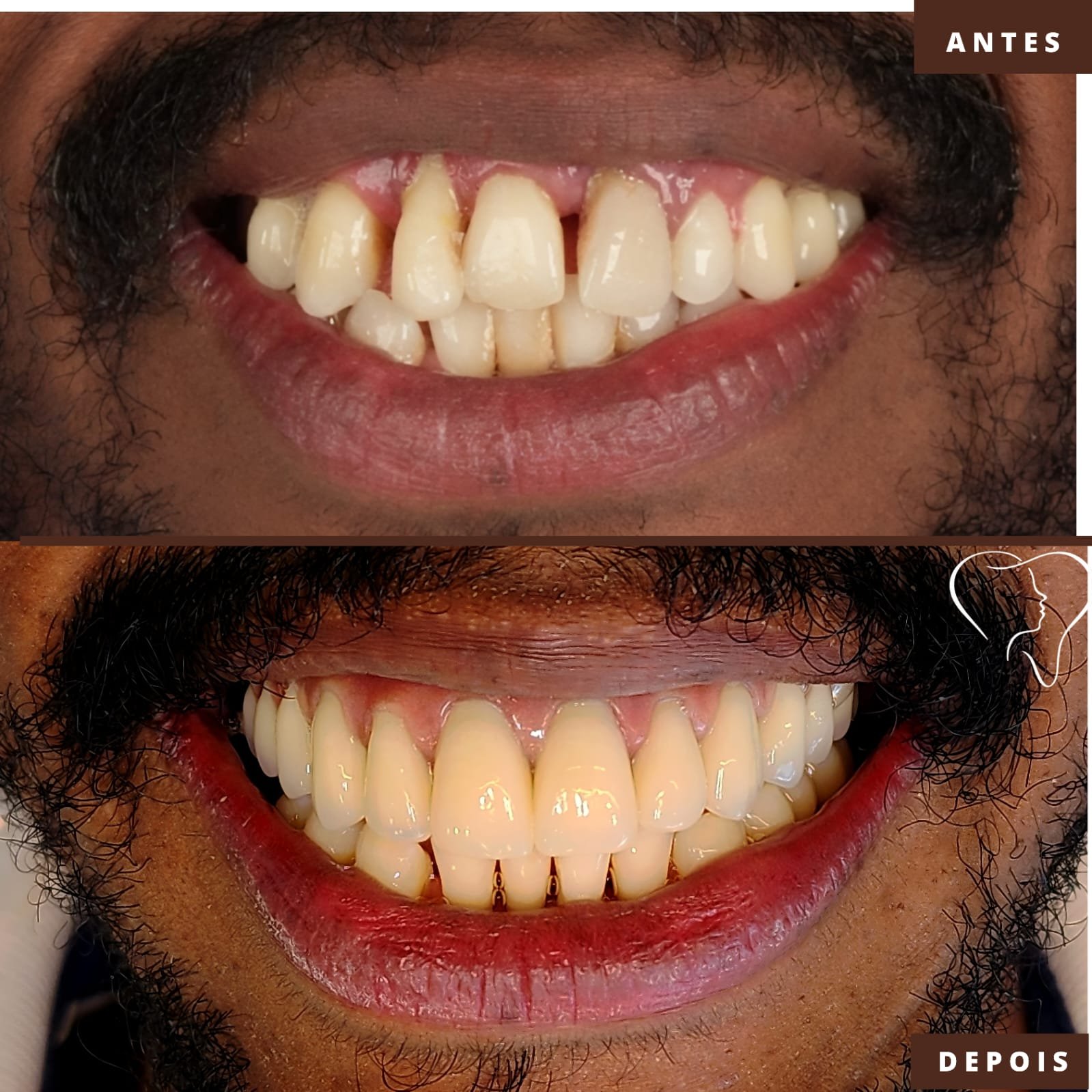 antes-e-depois-implantes-ouro-branco