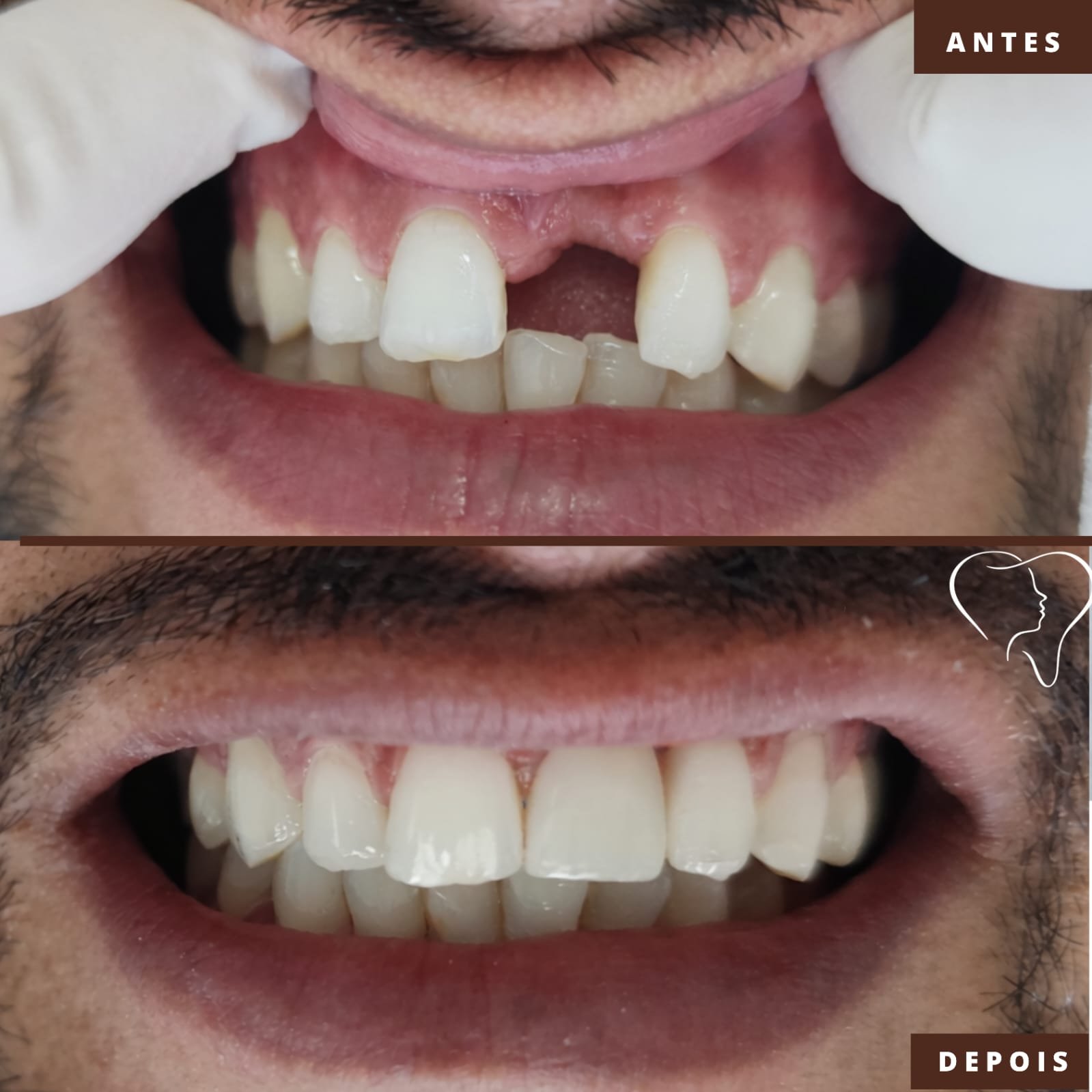 antes-e-depois-implnates-ouro-branco- (1)