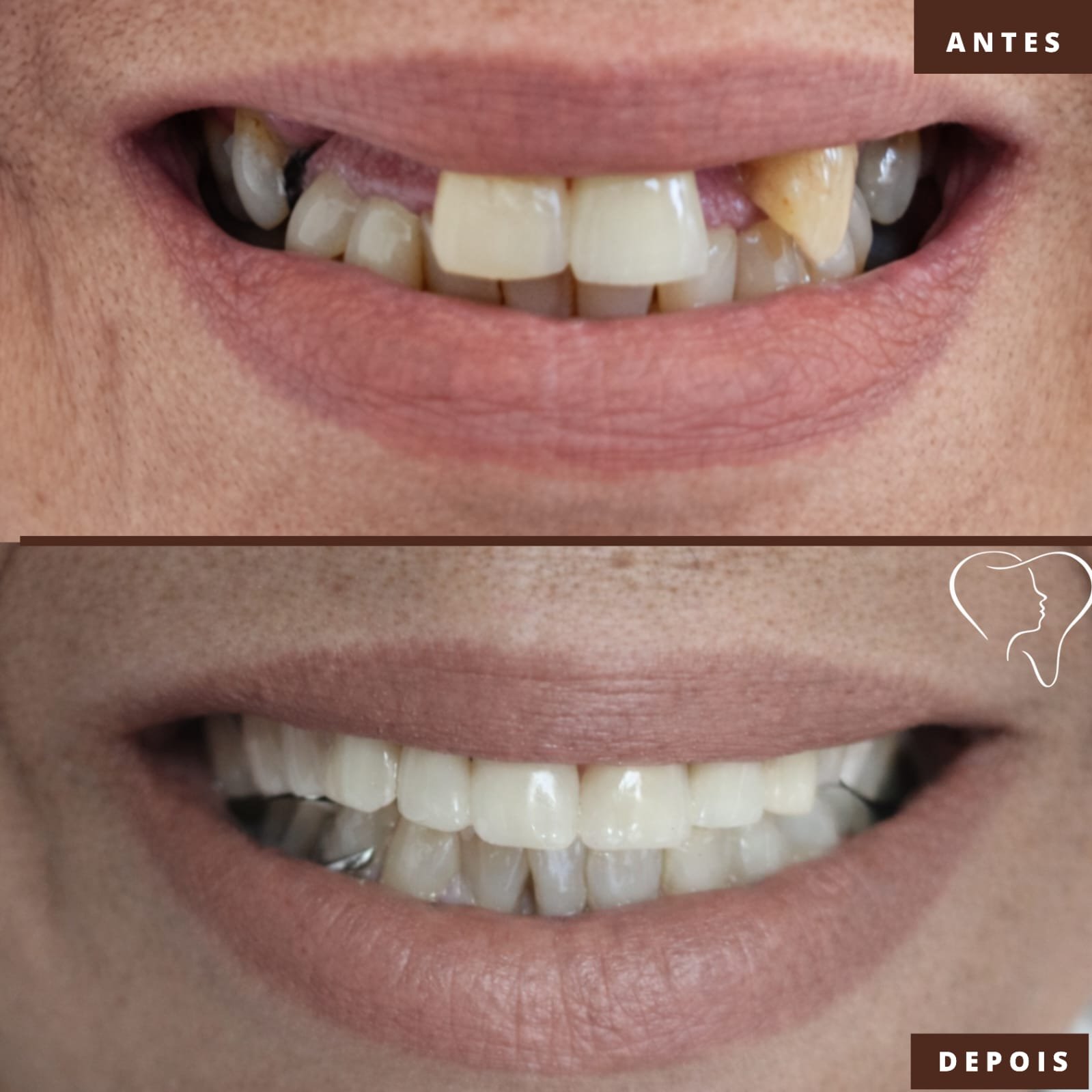 antes-e-depois-implnates-ouro-branco- (2)