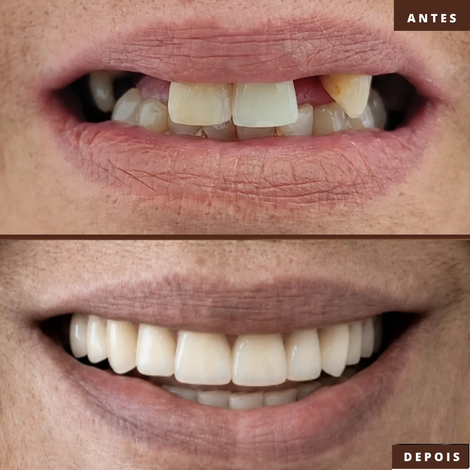 antes-depois-implante-protocolo-3