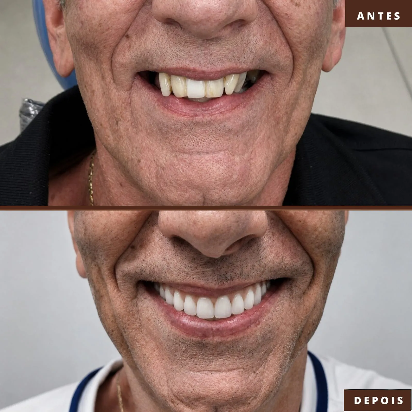 antes-depois-implante-protocolo-4