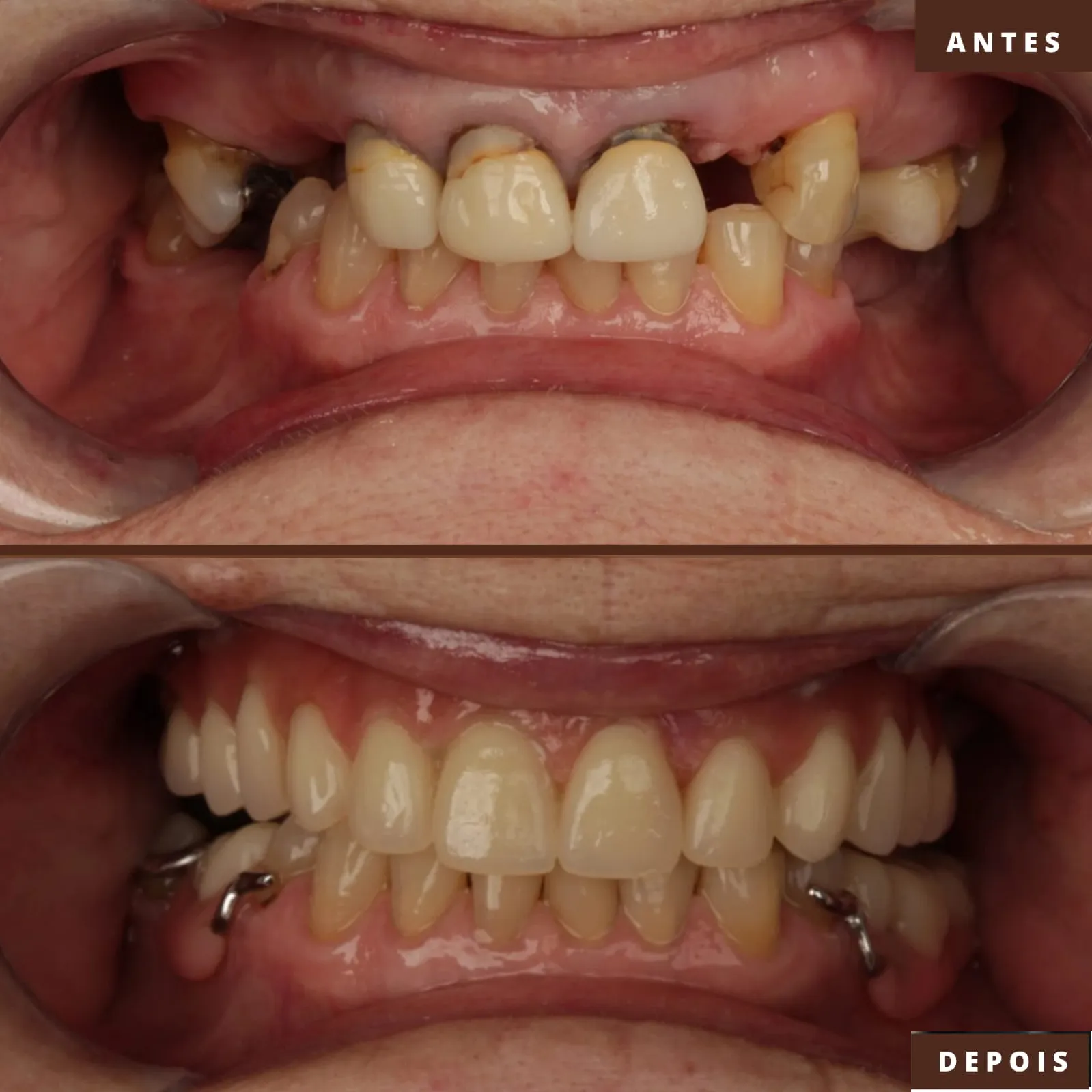 antes-depois-implante-protocolo