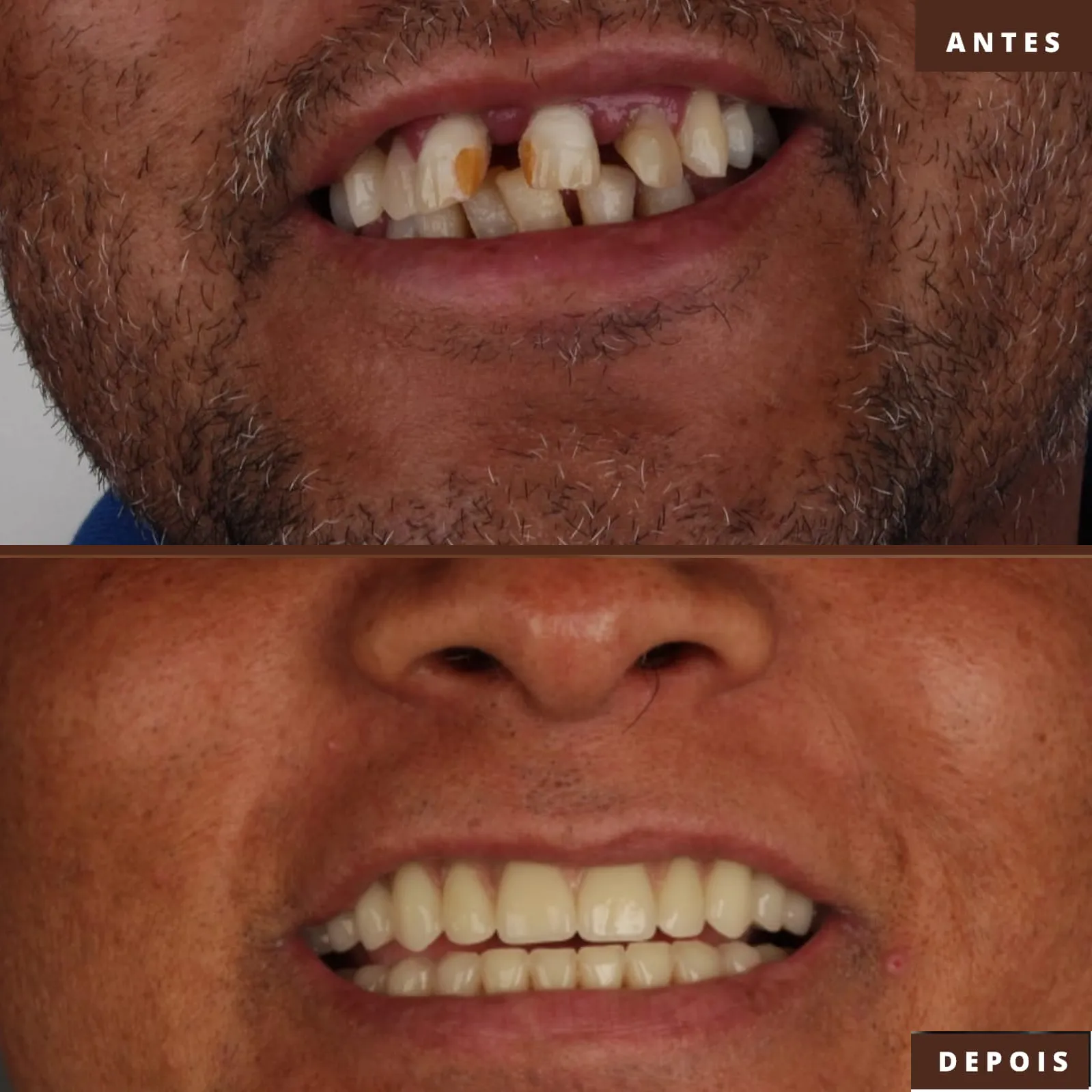antes-depois-implante-protocolo2